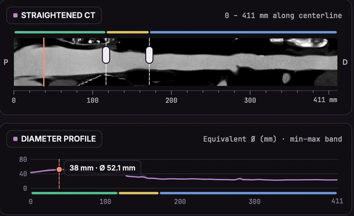 Straightened CT of the aorta over 411 mm with the diameter profile below it, the selected section marked at 38 mm with 52.1 mm