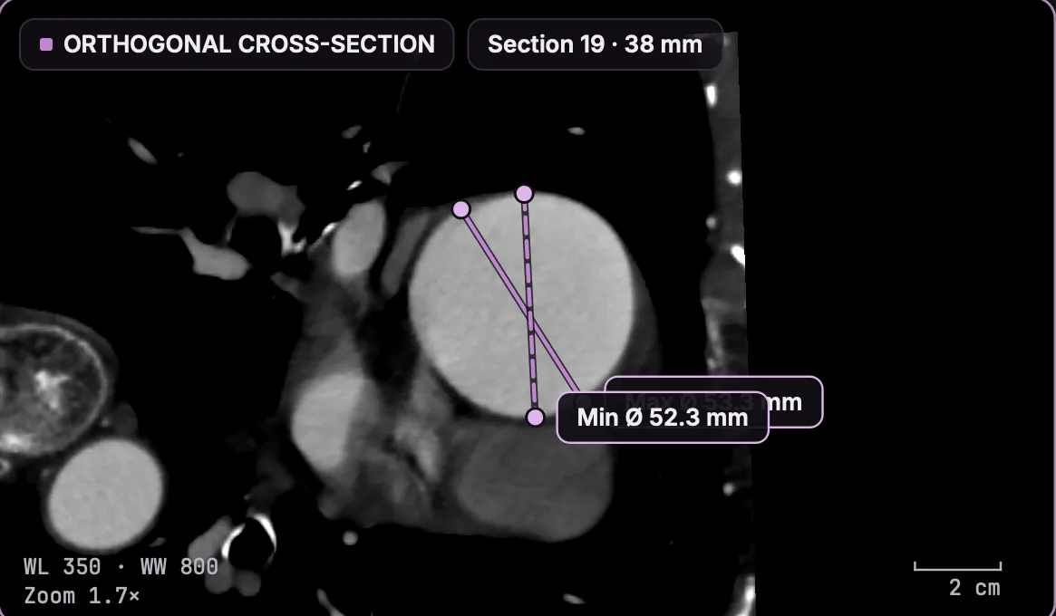 CT section perpendicular to the aortic centerline at 38 mm, with the minimum diameter of 52.3 mm drawn across the lumen