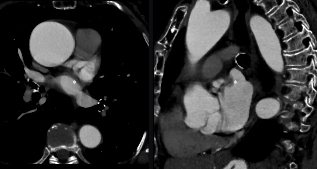 Axial and sagittal slices of a contrast-enhanced chest CT