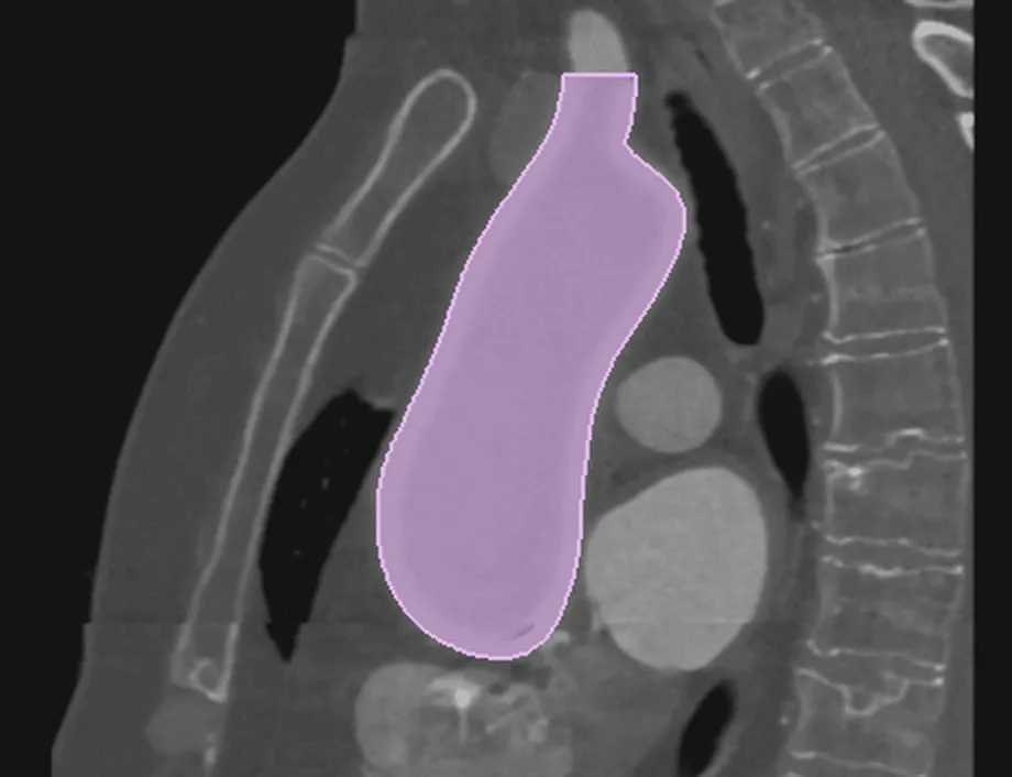 Sagittal CT slice with the vessel segmentation mask overlaid in lilac