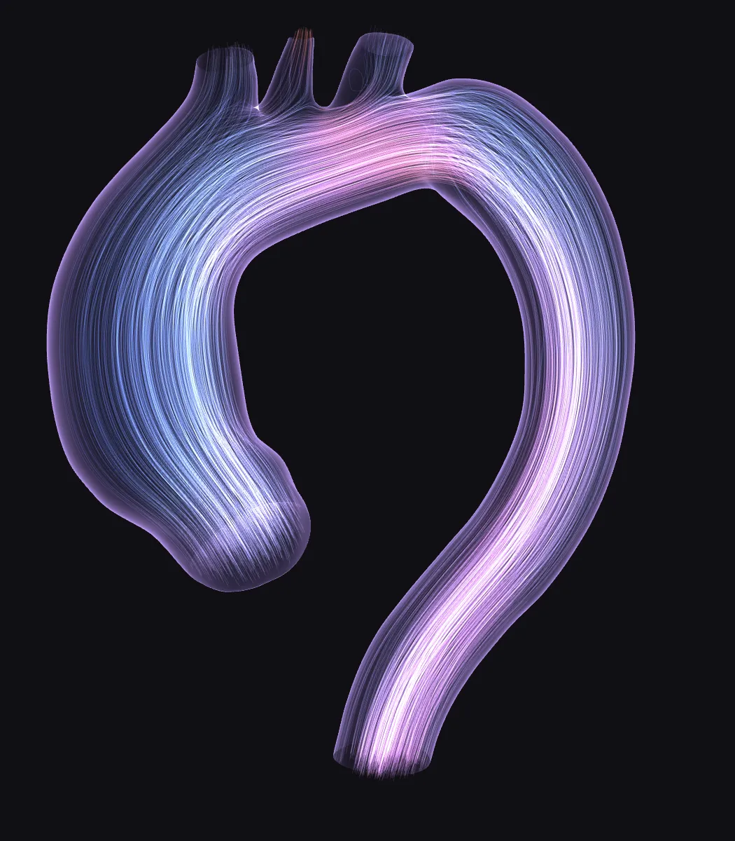 Simulated velocity streamlines through a whole patient-specific thoracic aorta at peak systole