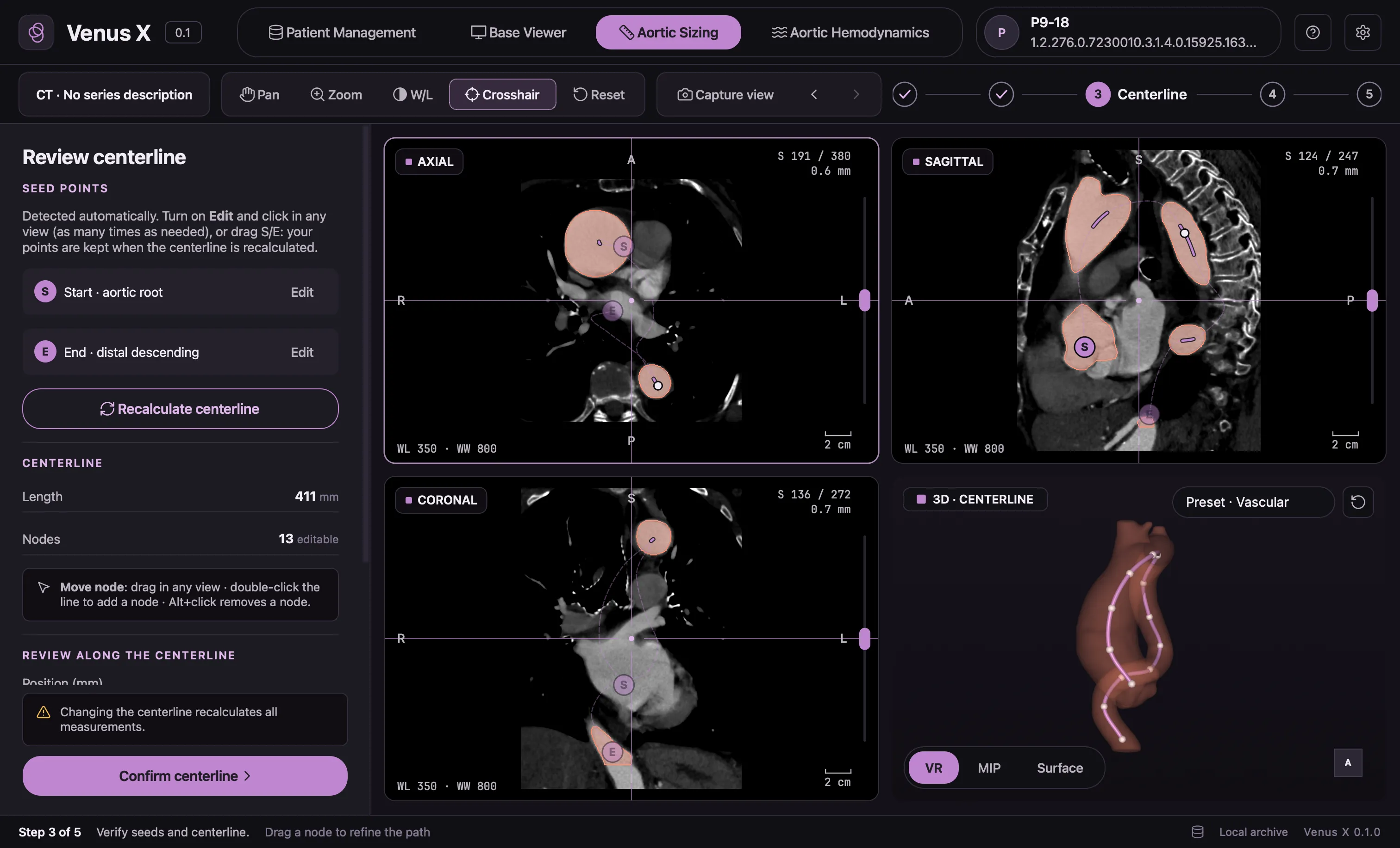 VenusX centerline review: seed points at the aortic root and distal descending aorta, lumen highlighted on CT planes, centerline nodes on the 3D aorta