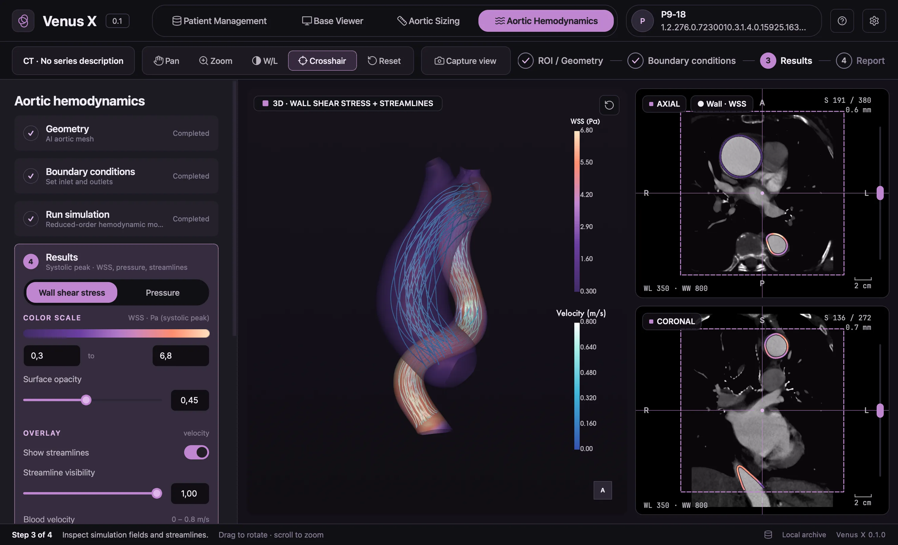 VenusX Flow development build: simulated wall shear stress in pascal and velocity streamlines in metres per second on the 3D aorta, with axial and coronal CT